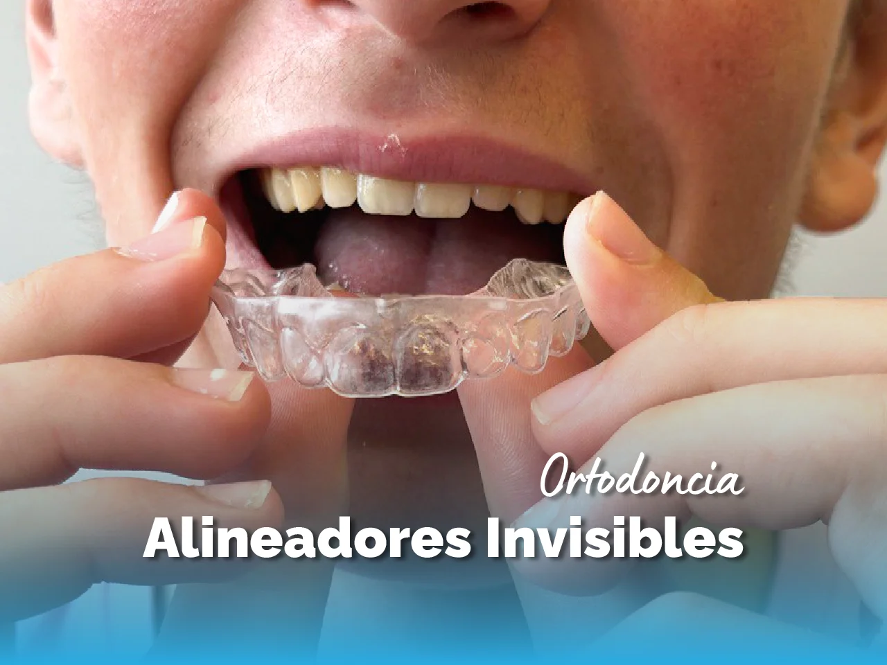 Alineadores Invisibles - Top Dental