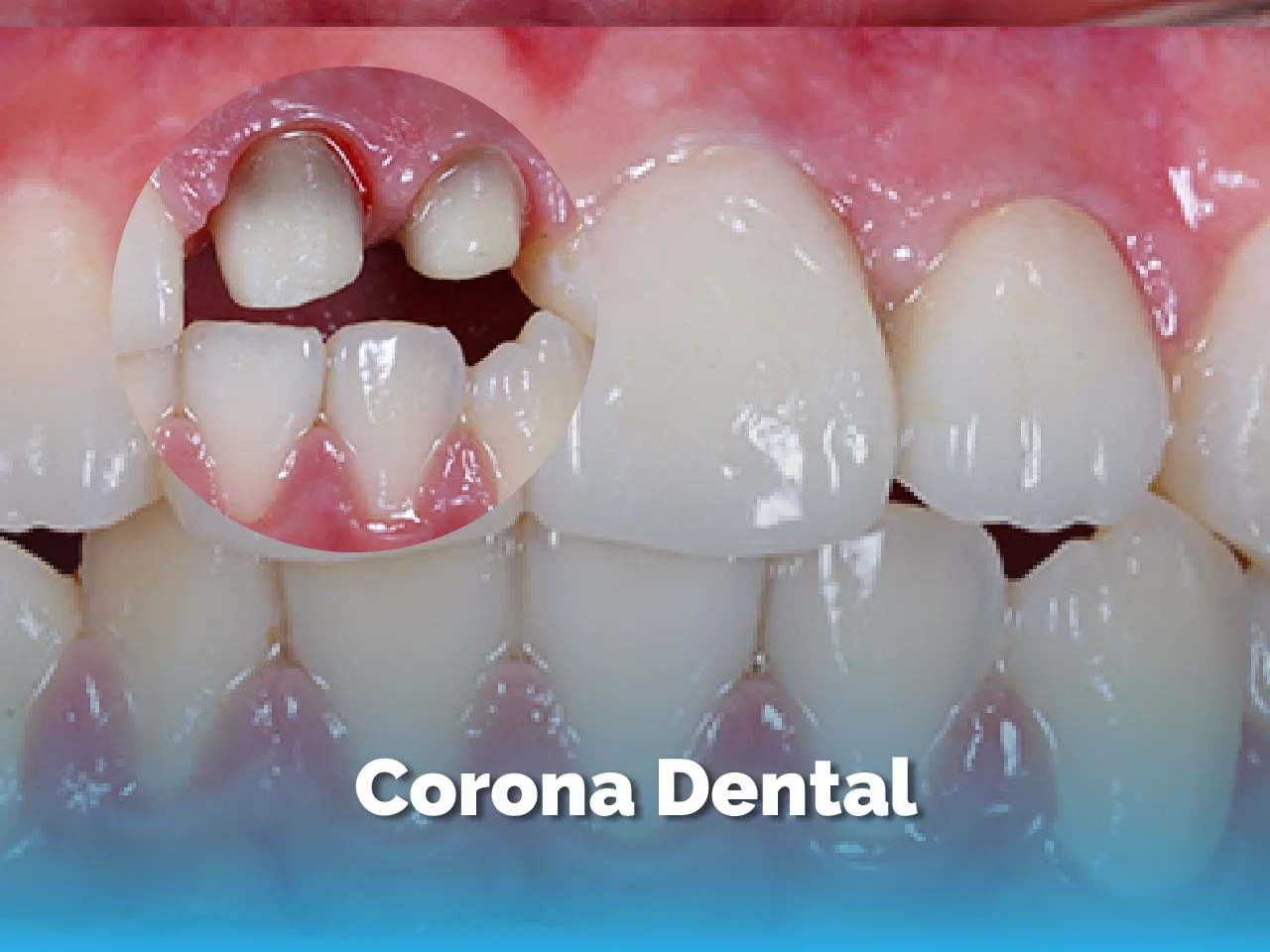 Corona Dental - Top Dental