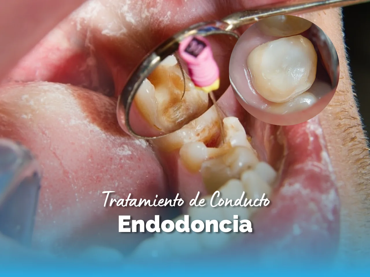 Endodoncia - Top Dental