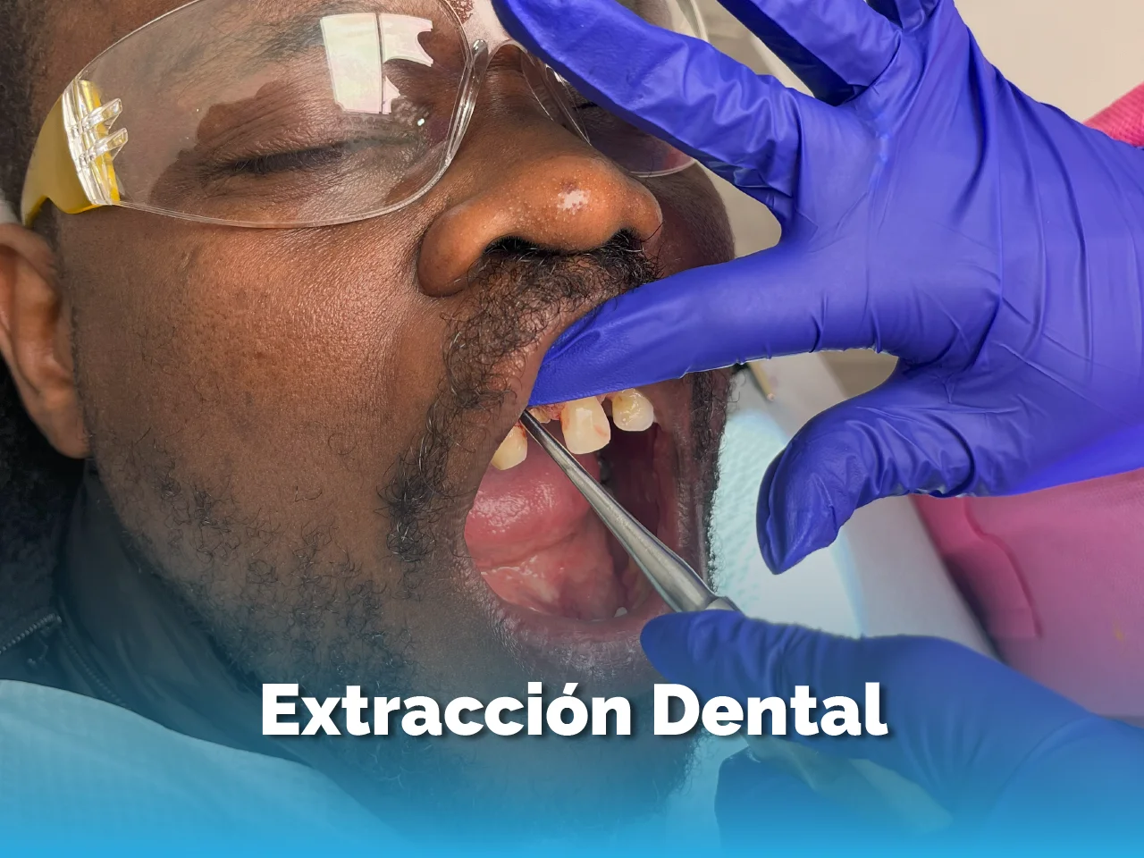 Extracción Dental - Top Dental