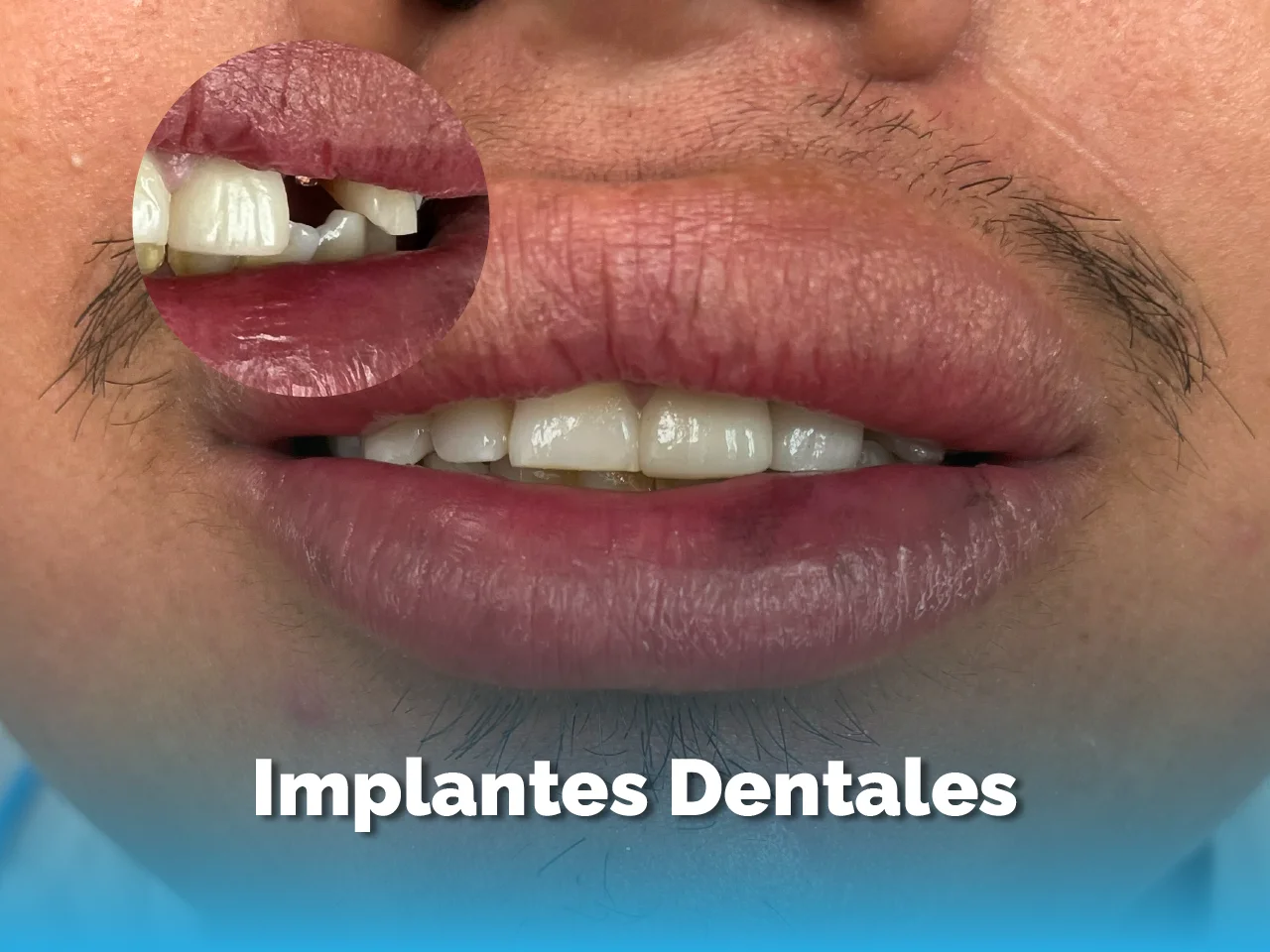 Implante Dental - Top Dental