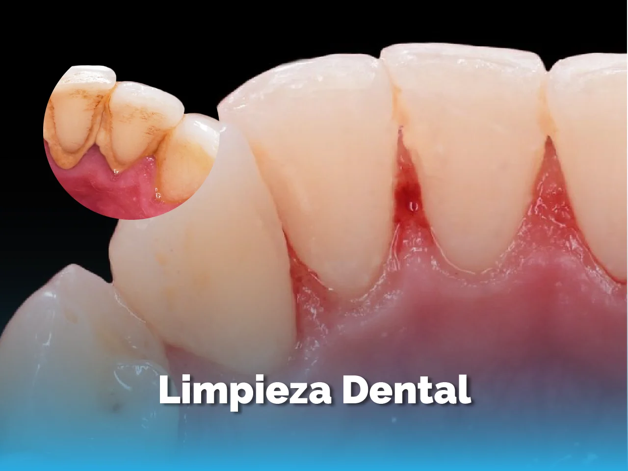 Limpieza Dental - Top Dental