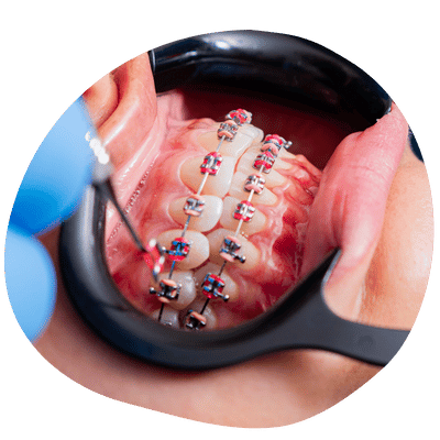 Consigue tus Brackets Metálicos en Top Dental