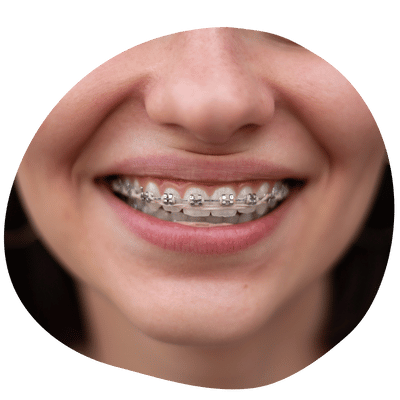 Paciente sonriendo con brackets metálicos en Top Dental
