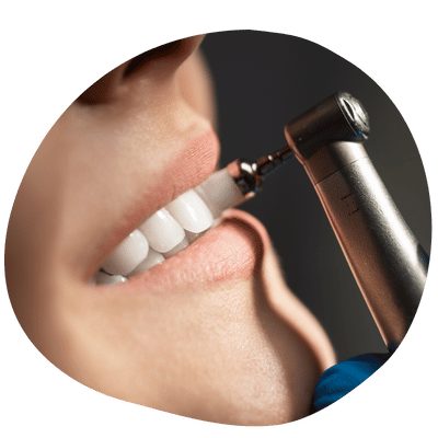 Limpieza dental profesional en Top Dental