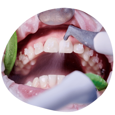 Limpieza dental profesional en Top Dental