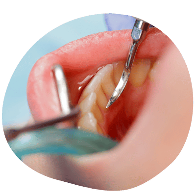 Limpieza Dental en Top Dental