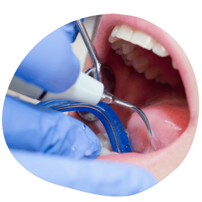 Limpieza Dental Profesional en Top Dental