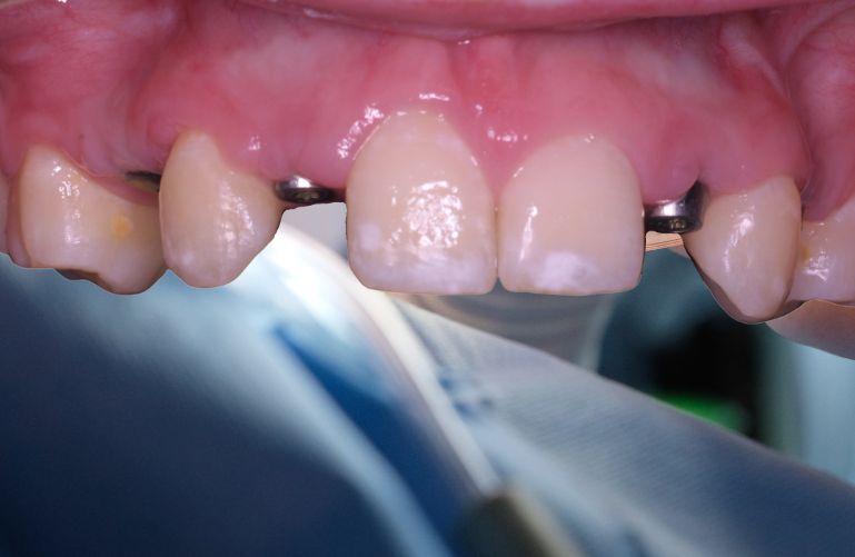 Paso 3: Cicatrización y Fusión ósea - Top Dental