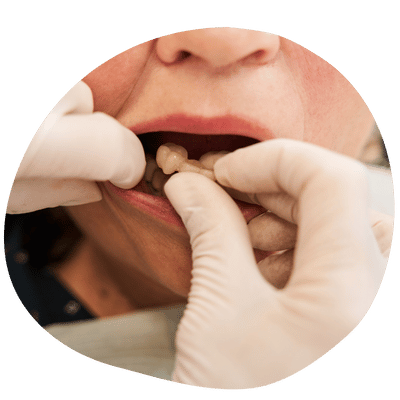 Dentaduras Removibles en Top Dental – Comodidad y Funcionalidad