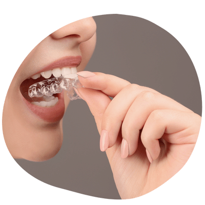 Paciente usando guarda dental personalizada de Top Dental