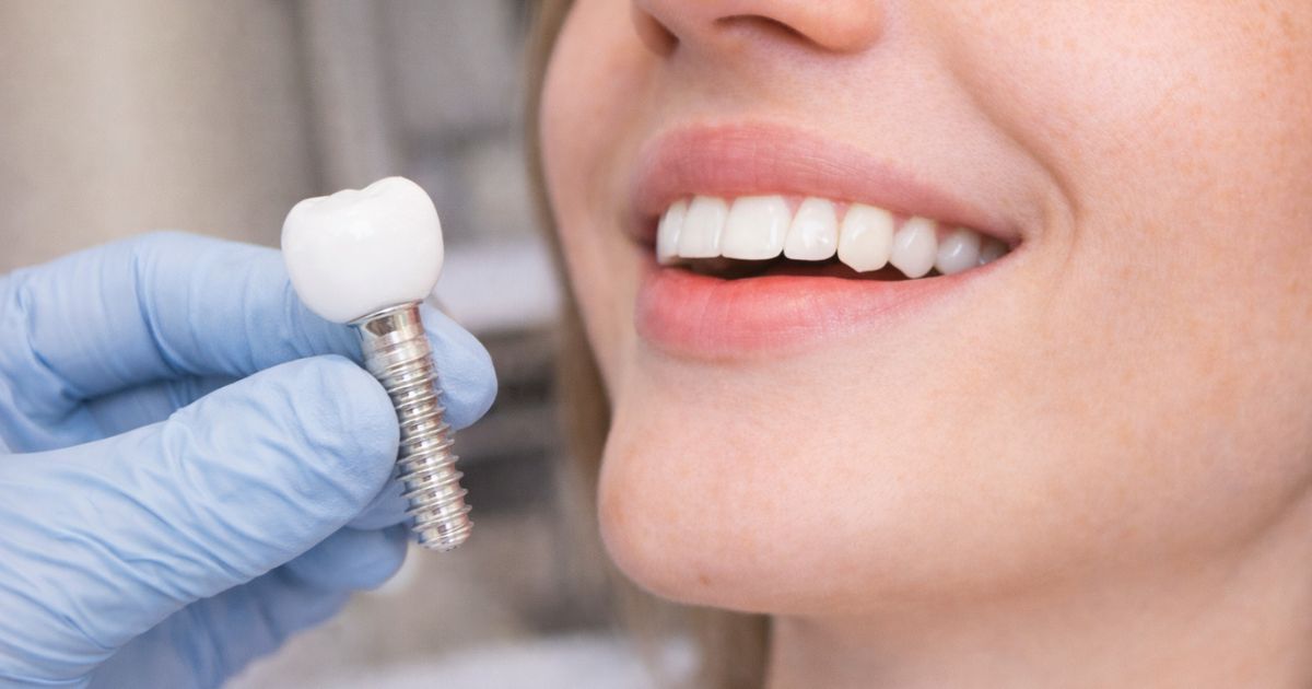 Promoción de implantes dentales en Top Dental