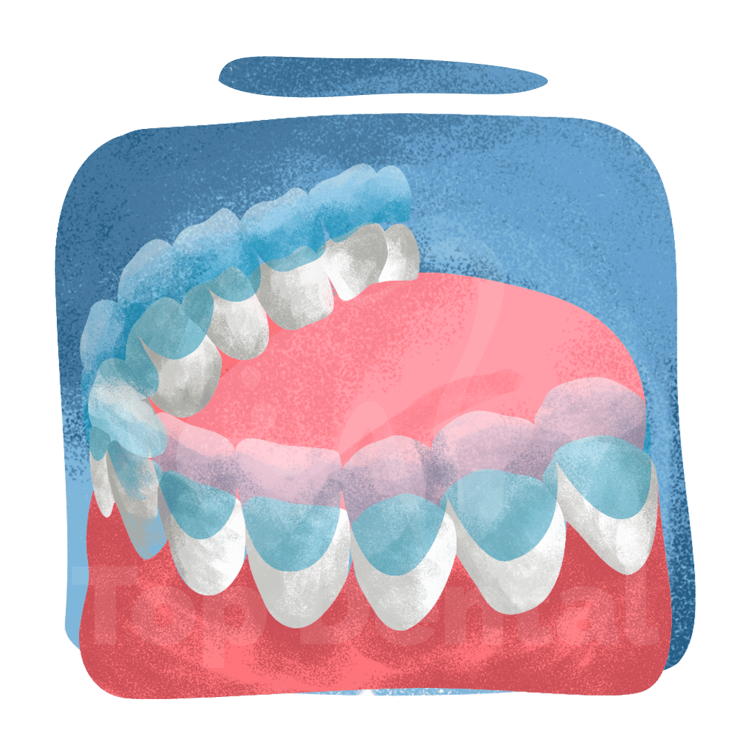 Alineadores, ortodoncia Top Dental