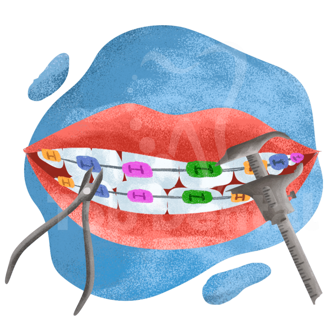 Ortodoncia, Brackets Top Dental
