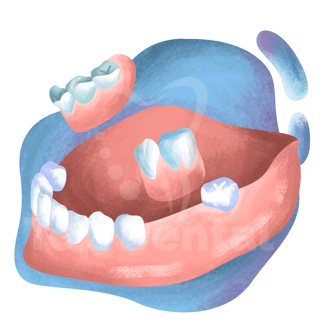 Parciales Removibles Top Dental