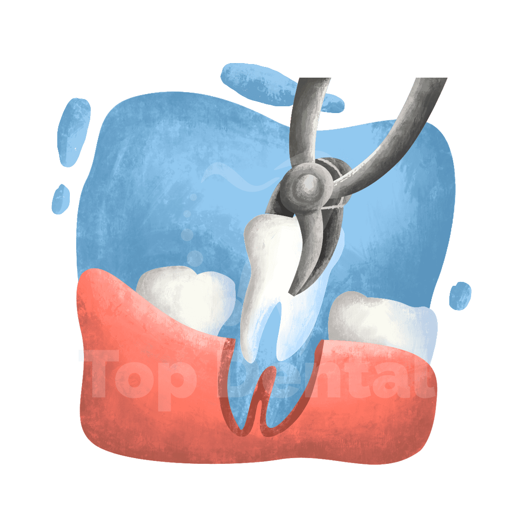 extracciones Top Dental