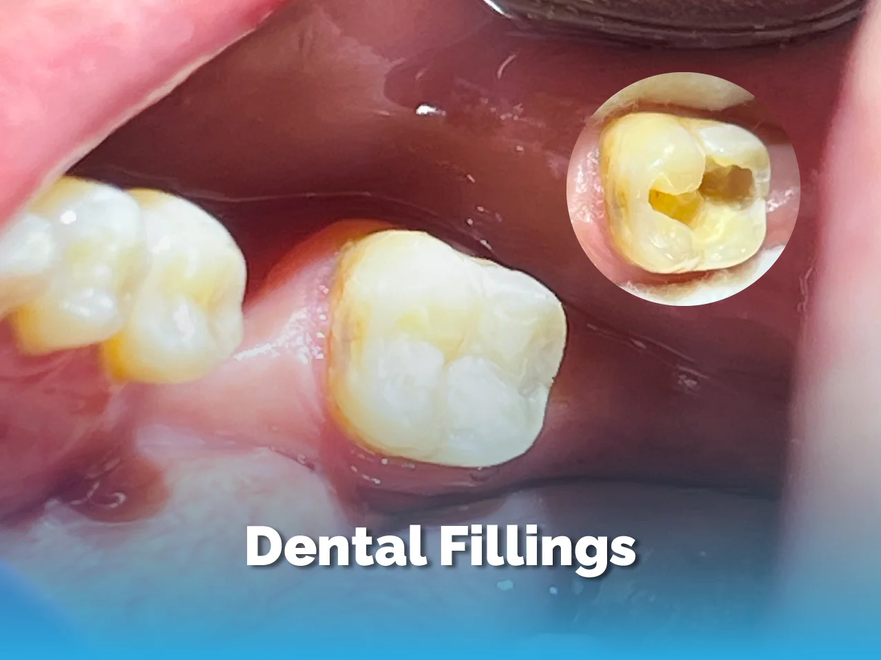 Dental Fillings - Top Dental