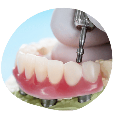 All-on-4 dental implants treatment at Top Dental Virginia and Maryland