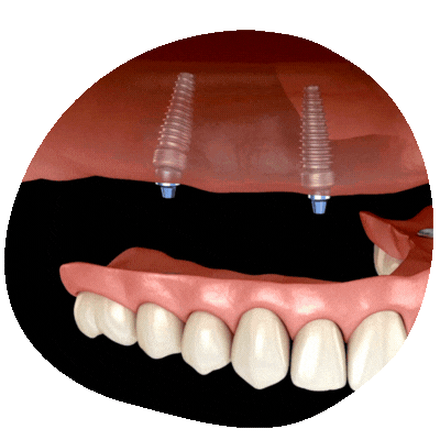 All-on-4 Dental Implants at Top Dental Virginia and Maryland