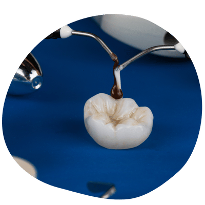 Dental Crown Treatment at Top Dental