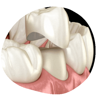 Dental Crowns at Top Dental