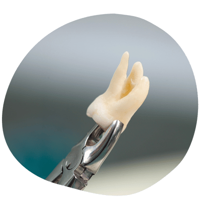 Painless tooth extraction in Virginia and Maryland by Top Dental