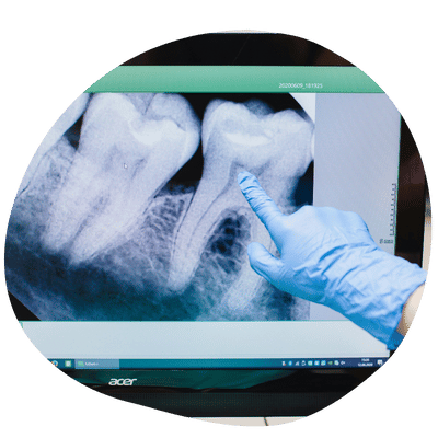 Patient undergoing dental evaluation for extraction at Top Dental