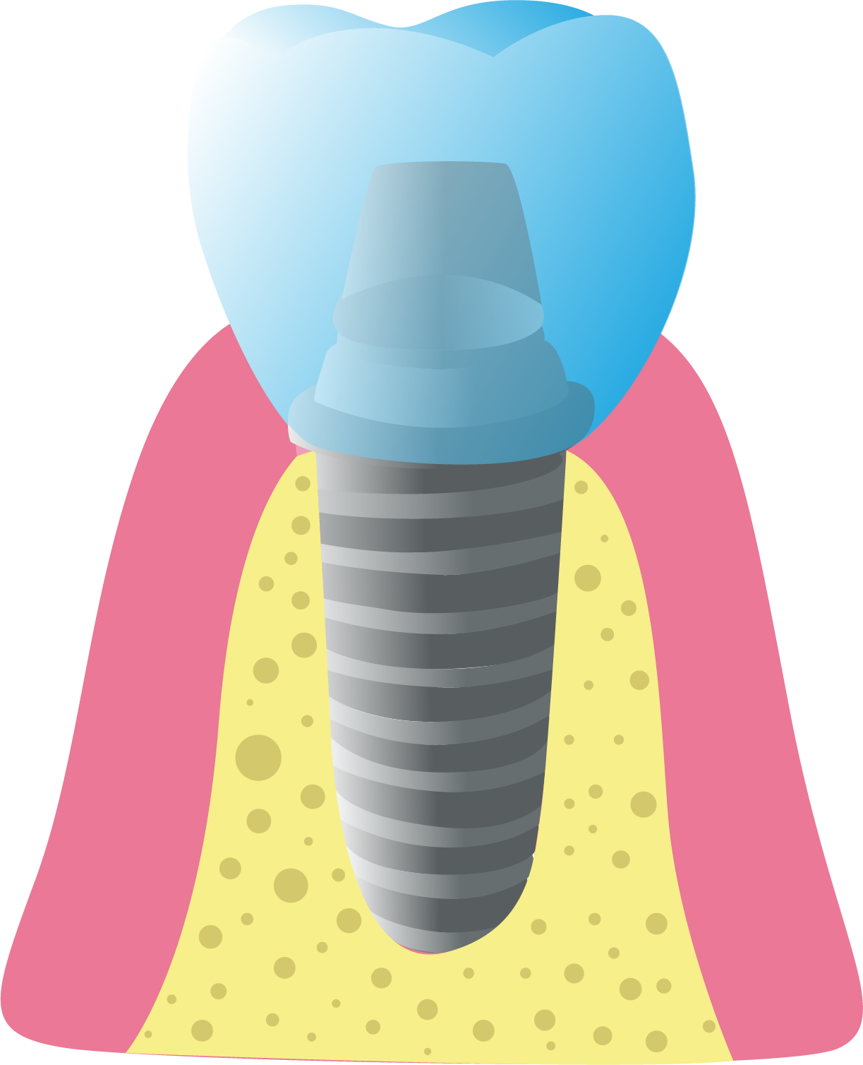 Dental Implant - Top Dental