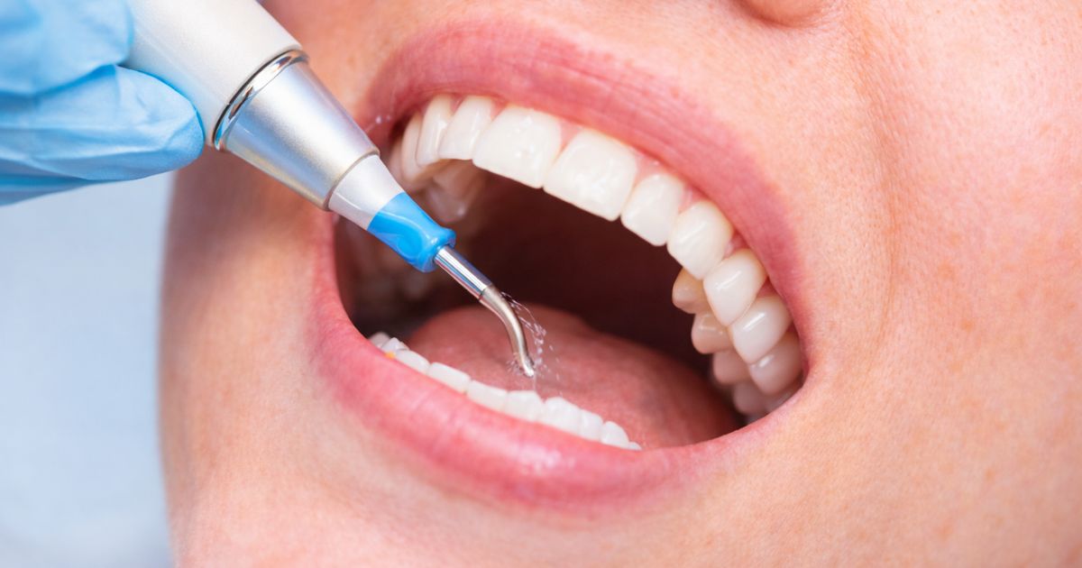 Deep cleaning dental deal at Top Dental