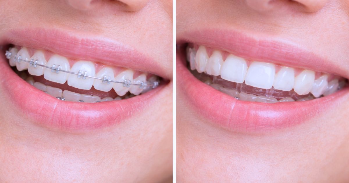 Orthodontics deal with braces and clear aligners at Top Dental