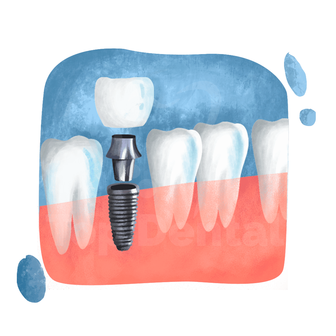 Top Dental Implants